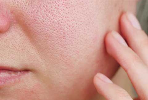 larged-pores